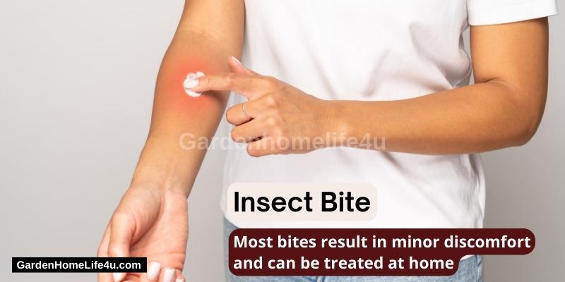 How To Treat Insect Bites Naturally 2