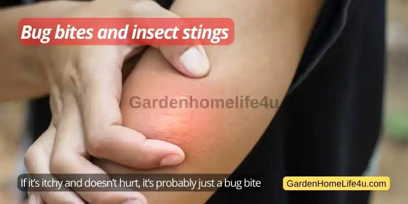 Common Bug Stings in the UK 11